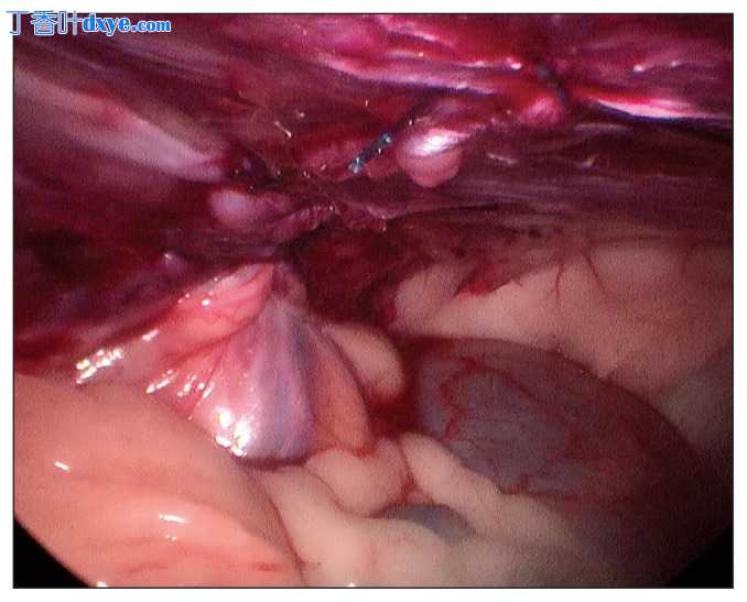 腹腔镜腹股沟疝修补术中带倒刺缝线