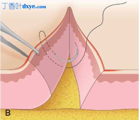 经皮后退真皮缝合