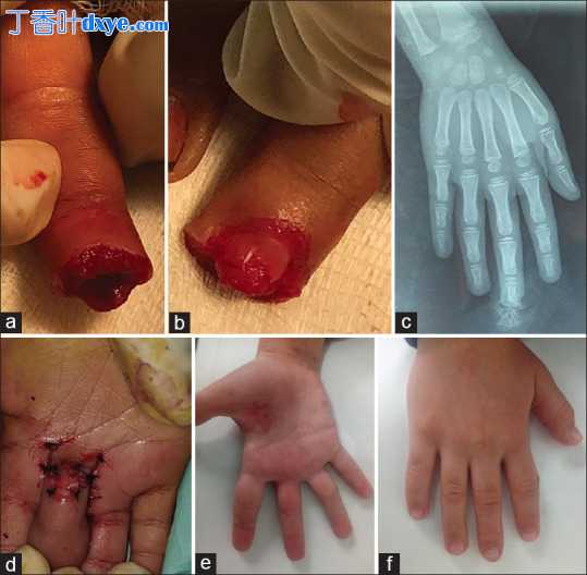 局部或远端皮瓣治疗儿童手指创伤
