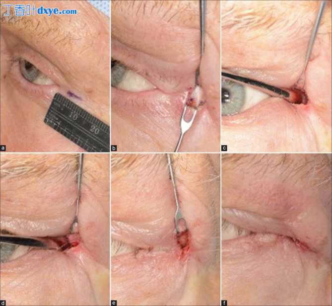 外眦肌腱内眦固定术的简化技术