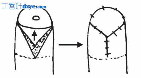 V-Y 推进皮瓣在指尖中的应用