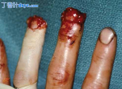 V-Y 推进皮瓣在指尖中的应用