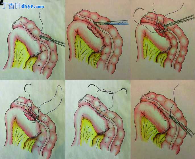 腹腔镜右结肠切除术中体外手工缝合与体内机械吻合