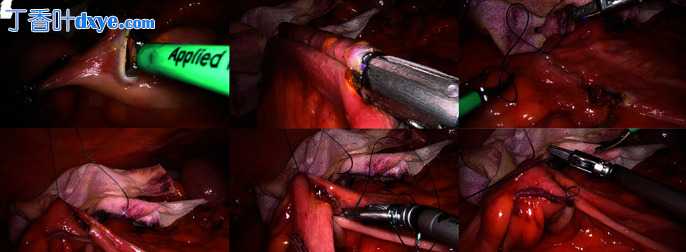腹腔镜右结肠切除术中体外手工缝合与体内机械吻合