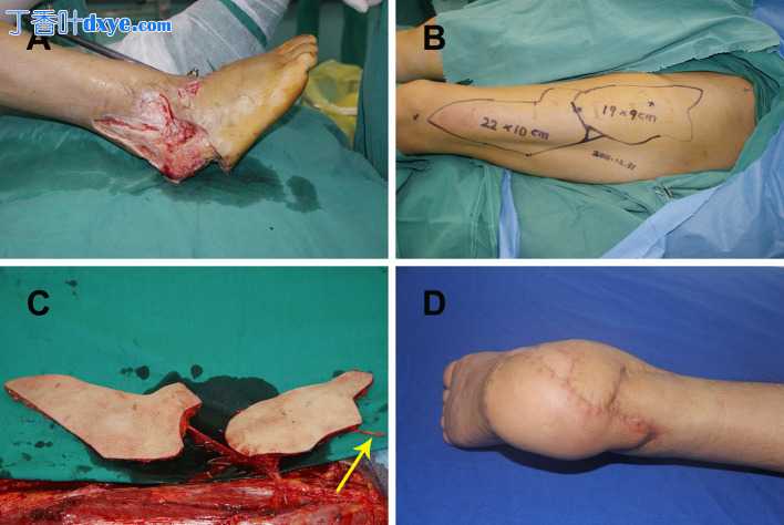 多功能双皮桨大腿前外侧穿支皮瓣重建足跟复杂软组织缺损