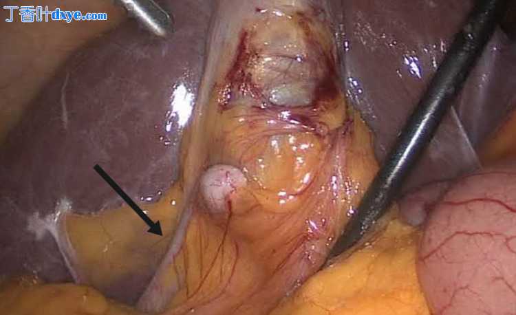 腹腔镜胆囊切除术中发现阑尾与胆囊粘连一例