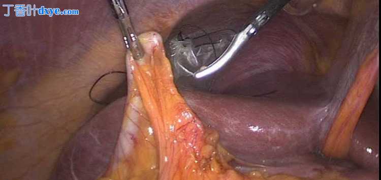 腹腔镜胆囊切除术中发现阑尾与胆囊粘连一例