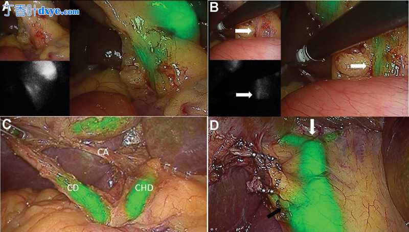 近红外荧光引导腹腔镜胆囊切除术在复杂胆结石疾病谱中的应