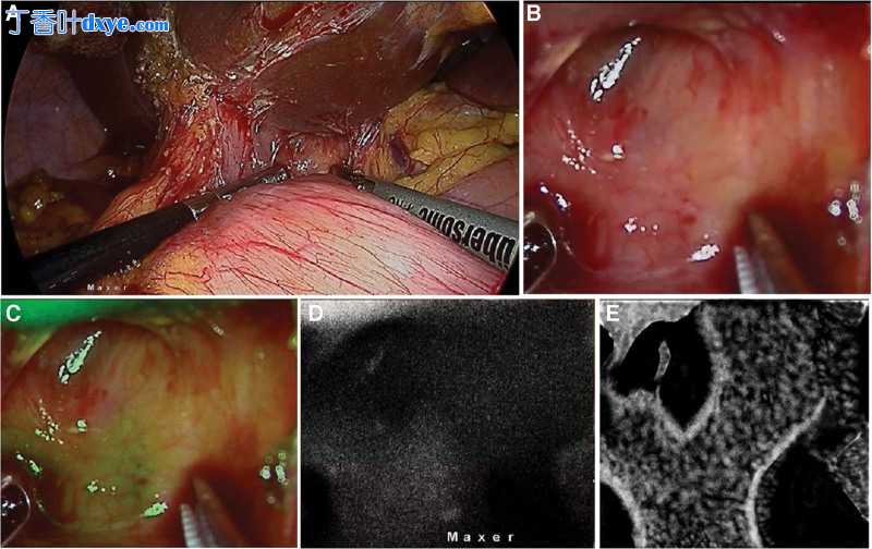 近红外荧光引导腹腔镜胆囊切除术在复杂胆结石疾病谱中的应