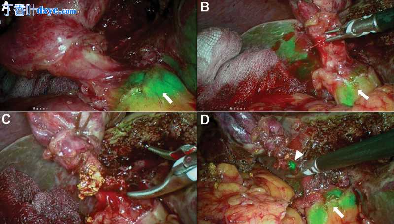 近红外荧光引导腹腔镜胆囊切除术在复杂胆结石疾病谱中的应