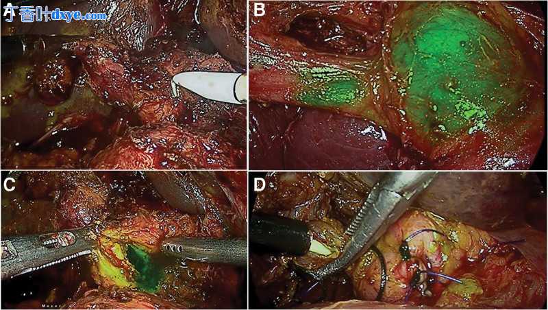 近红外荧光引导腹腔镜胆囊切除术在复杂胆结石疾病谱中的应