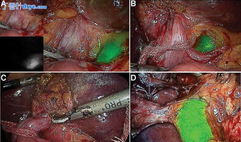 近红外荧光引导腹腔镜胆囊切除术在复杂胆结石疾病谱中的应