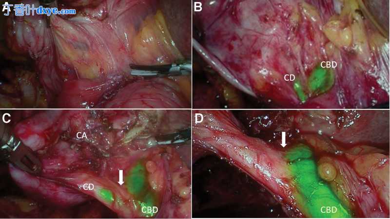 近红外荧光引导腹腔镜胆囊切除术在复杂胆结石疾病谱中的应