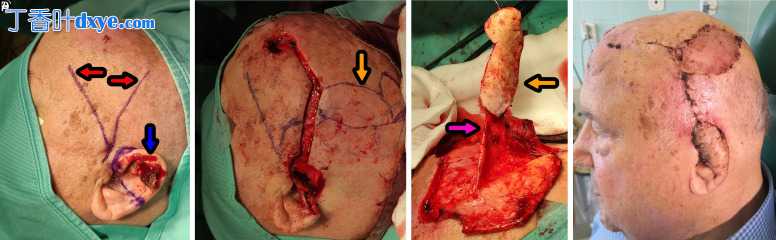 颞顶筋膜肌和颞顶带蒂皮瓣再造耳廓的手术效果