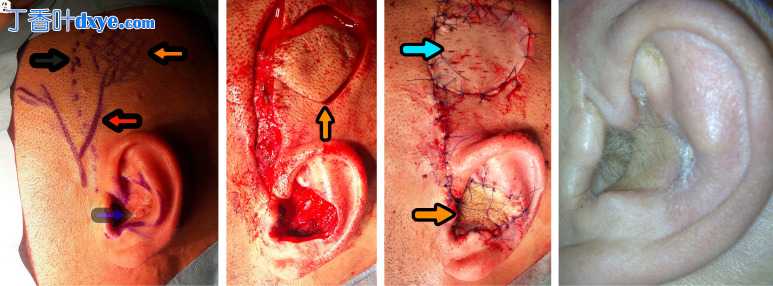 颞顶筋膜肌和颞顶带蒂皮瓣再造耳廓的手术效果