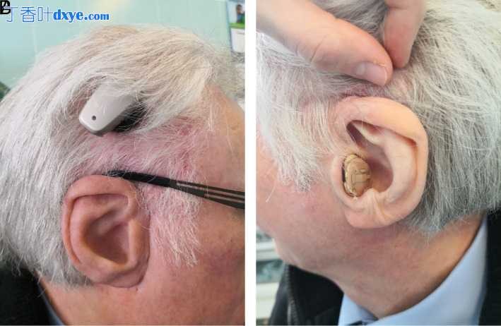 颞顶筋膜肌和颞顶带蒂皮瓣再造耳廓的手术效果