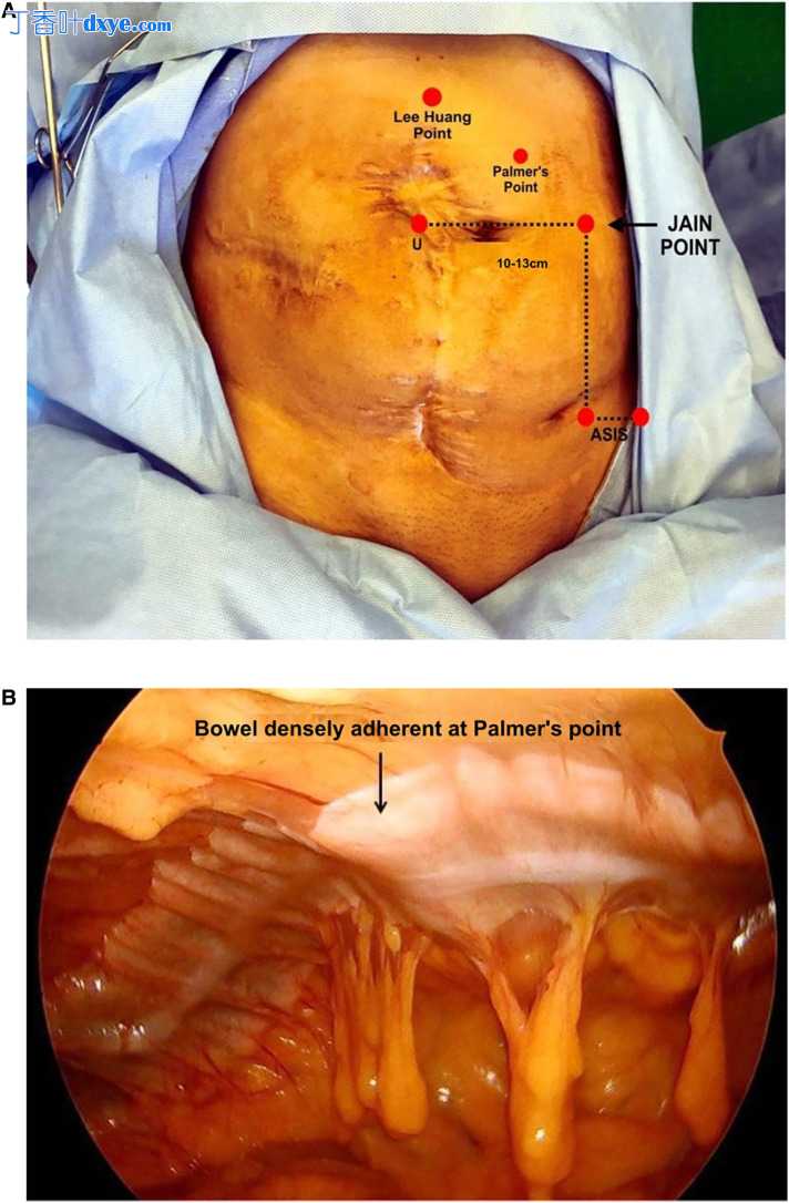 Palmers点禁忌症中的Jain点腹腔镜入路
