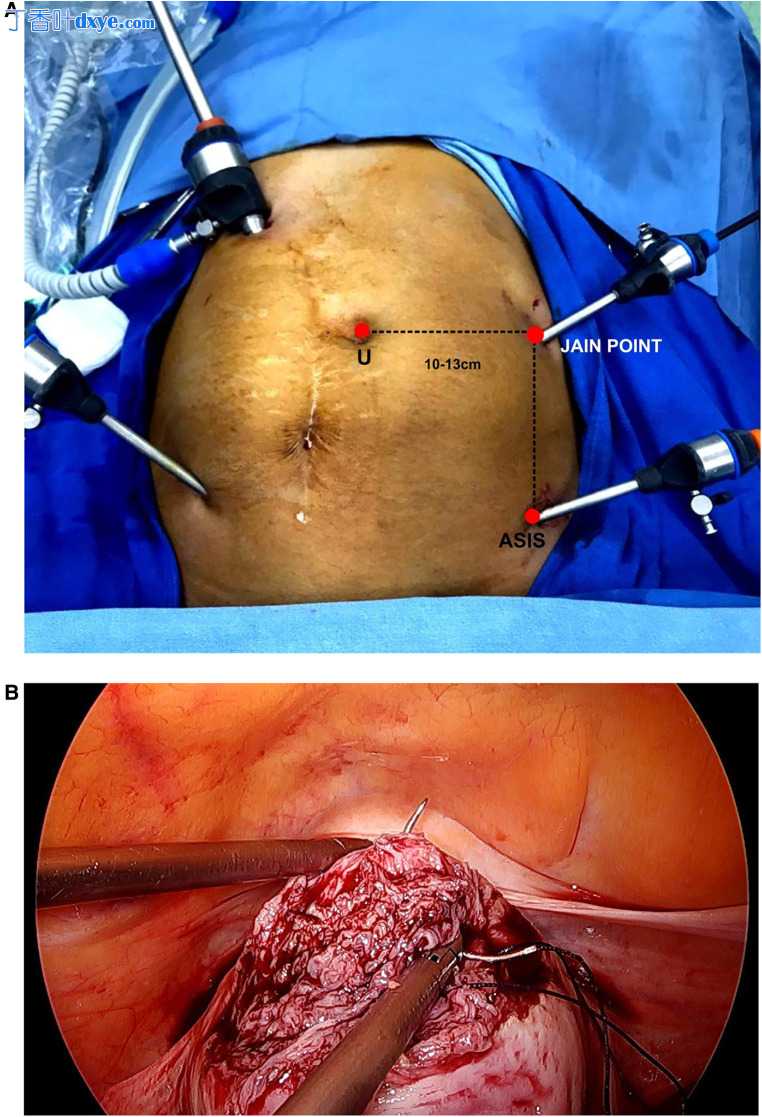 Palmers点禁忌症中的Jain点腹腔镜入路