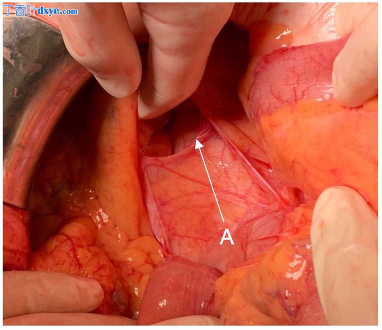 腹腔镜乙状结肠切除术后内疝