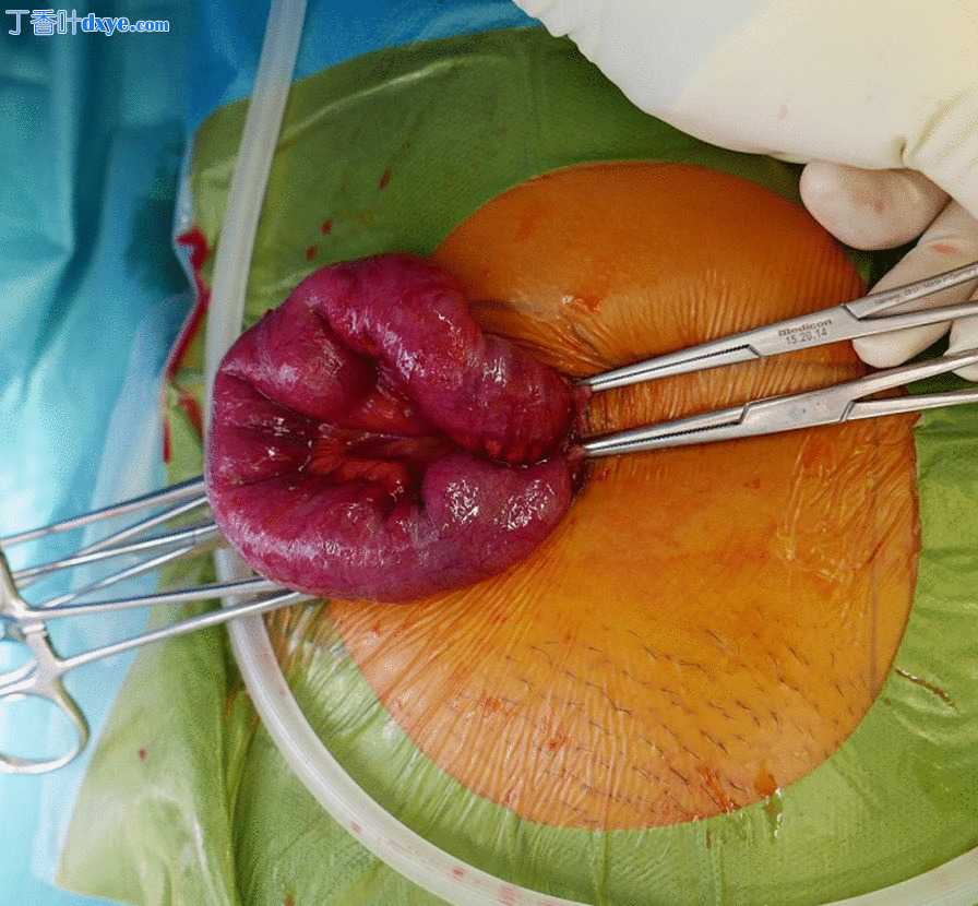 腹腔镜输卵管卵巢切除术后套管针部位疝