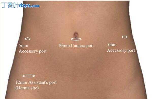 腹腔镜输卵管卵巢切除术后套管针部位疝