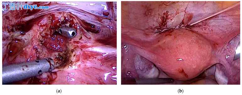 腹腔镜荧光引导检测子宫壁龛——下一步手术诊断和治疗