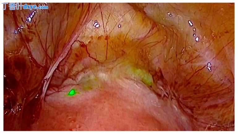 腹腔镜荧光引导检测子宫壁龛——下一步手术诊断和治疗