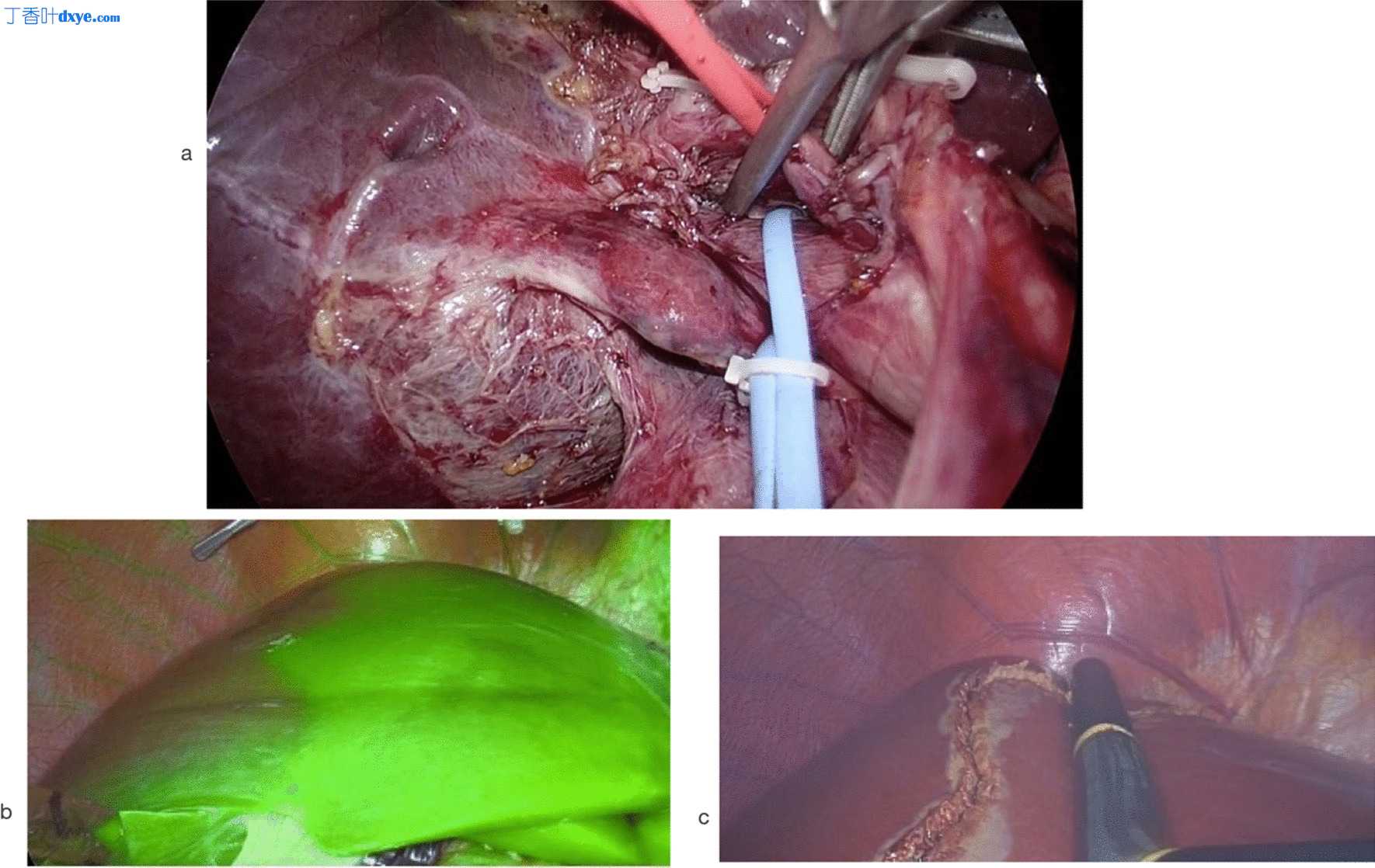 纯腹腔镜和开放供体右肝切除术的比较结果：来自东南亚移植中心的一份报告