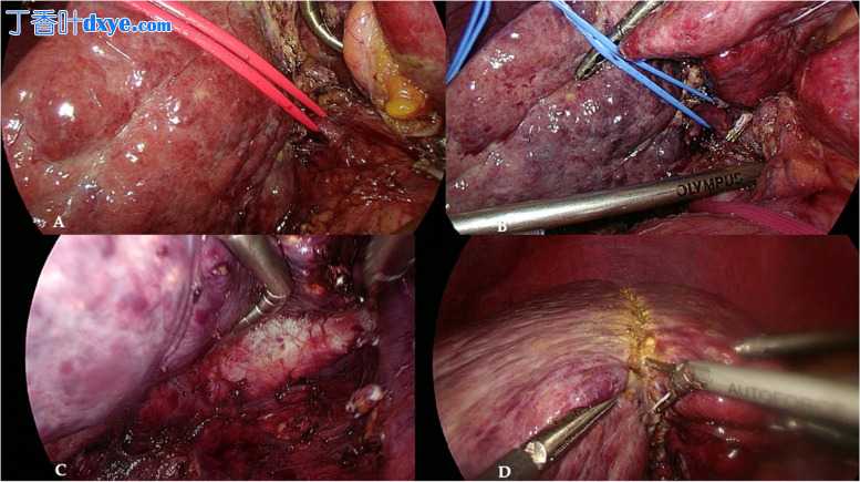 腹腔镜大肝切除方案实施的早期成果