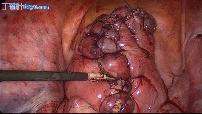 使用显微外科血管夹系统暂时双侧闭塞四个主要子宫血管，用于腹腔镜下非常大的壁间...