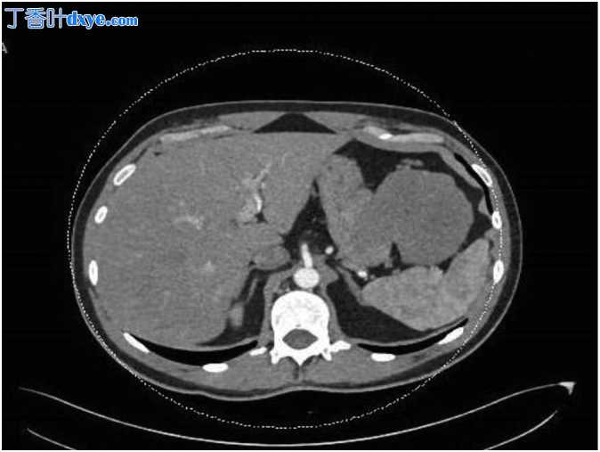 胃大出血 GIST 腹腔镜胃部分切除术：病例报告