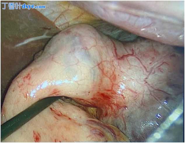 胃大出血 GIST 腹腔镜胃部分切除术：病例报告