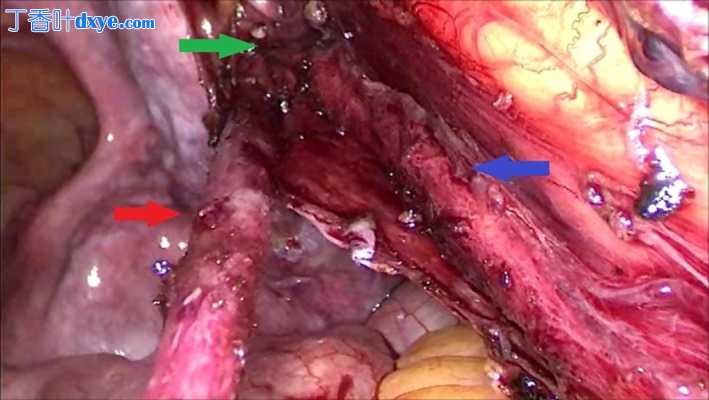 输尿管双裂盲端一例报告:腹腔镜手术处理