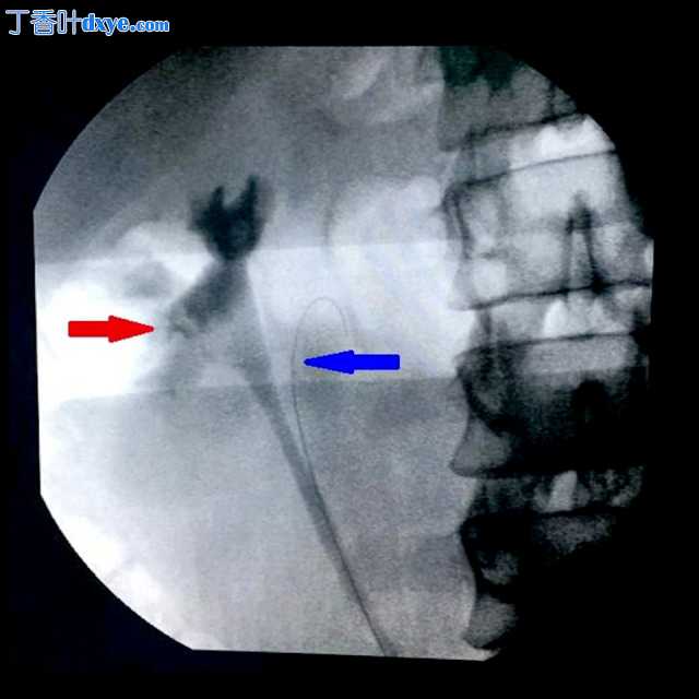 输尿管双裂盲端一例报告:腹腔镜手术处理