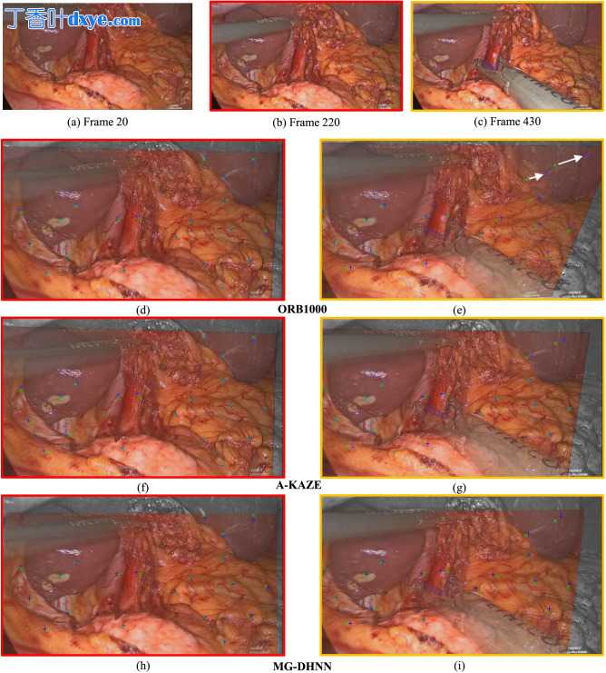 结合腹腔镜视频和光谱图像数据的图像配准方法比较