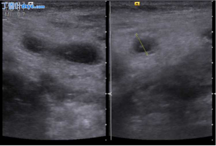 小儿腹腔镜左侧阑尾切除术一例报告
