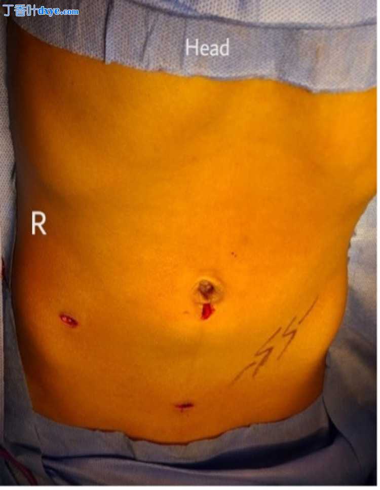 小儿腹腔镜左侧阑尾切除术一例报告