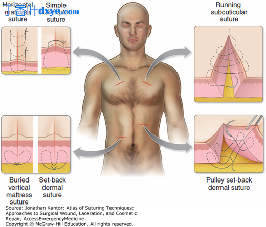 胸部、背部和肩部解剖位置的缝合技巧和方法