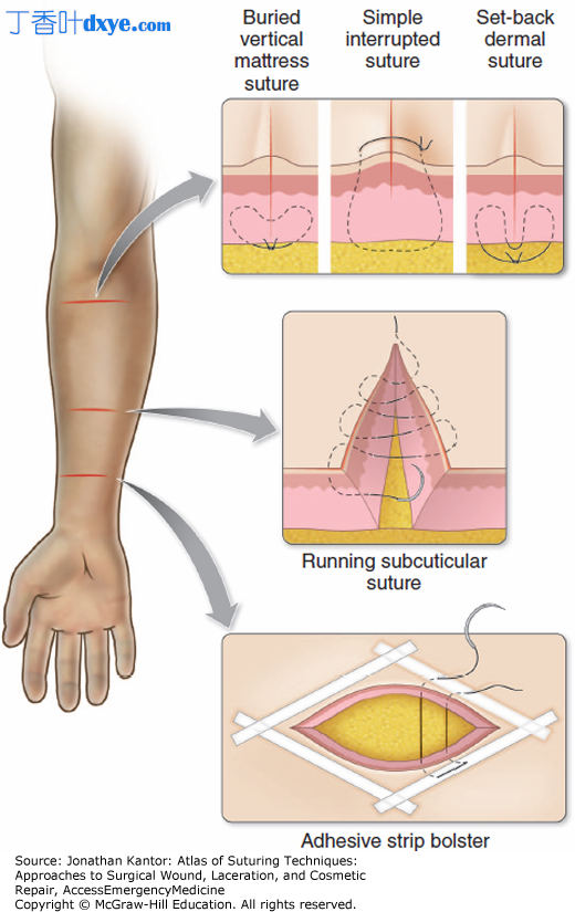 按解剖位置分类的手臂缝合技巧和方法