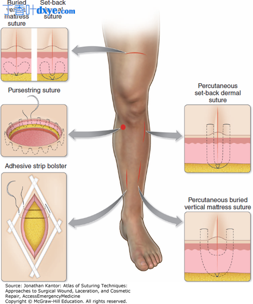 腿部解剖位置的缝合技巧和方法