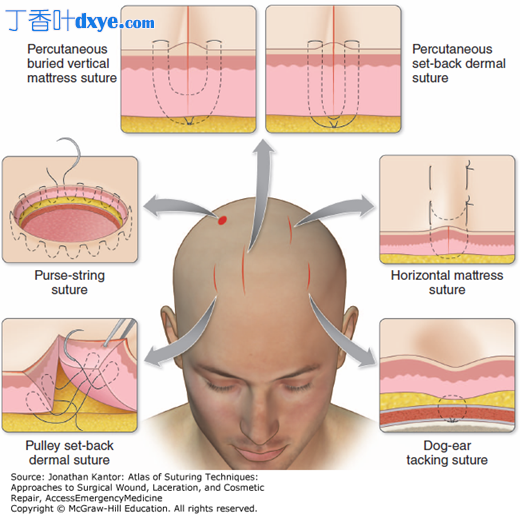 头皮解剖位置的缝合技巧和方法