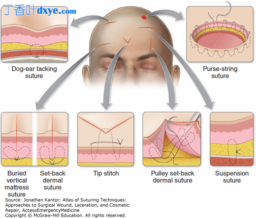 前额解剖位置的缝合技巧和方法