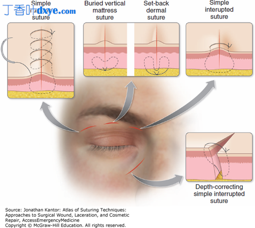 眼睑解剖位置的缝合技巧和方法