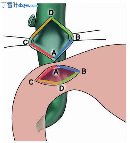 胆肠旁路术在胆道结石病管理中的作用