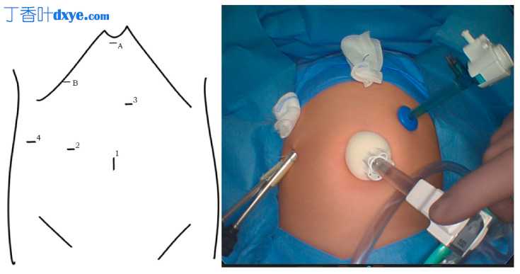 婴儿胆总管囊肿切除术——一项回顾性研究