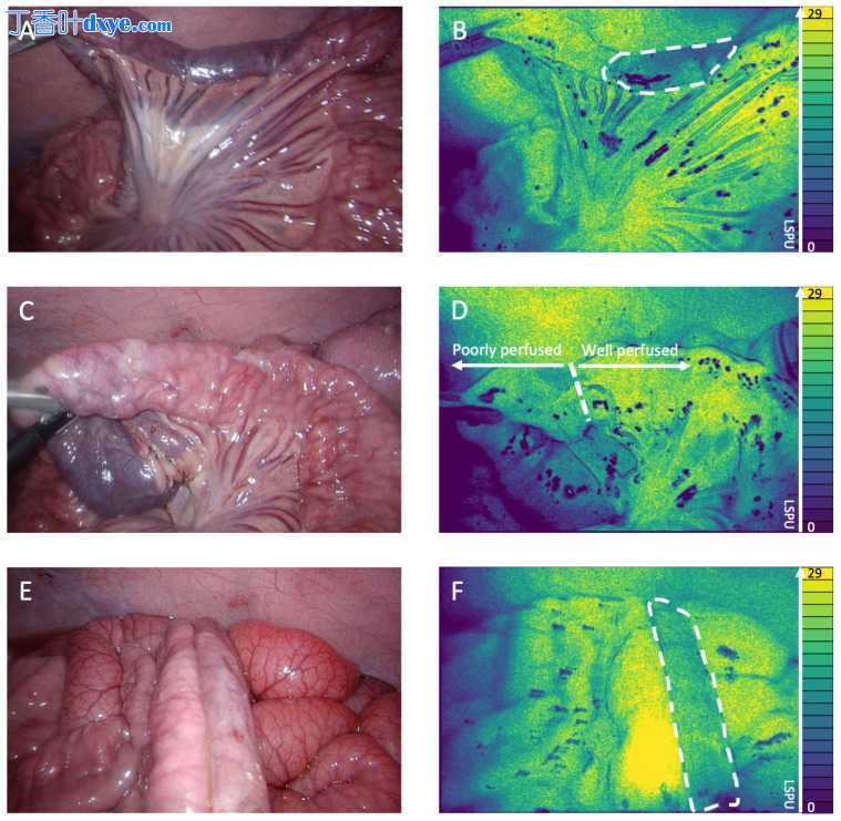 腹腔镜激光散斑对比成像可以可视化吻合灌注：在猪模型中的演示