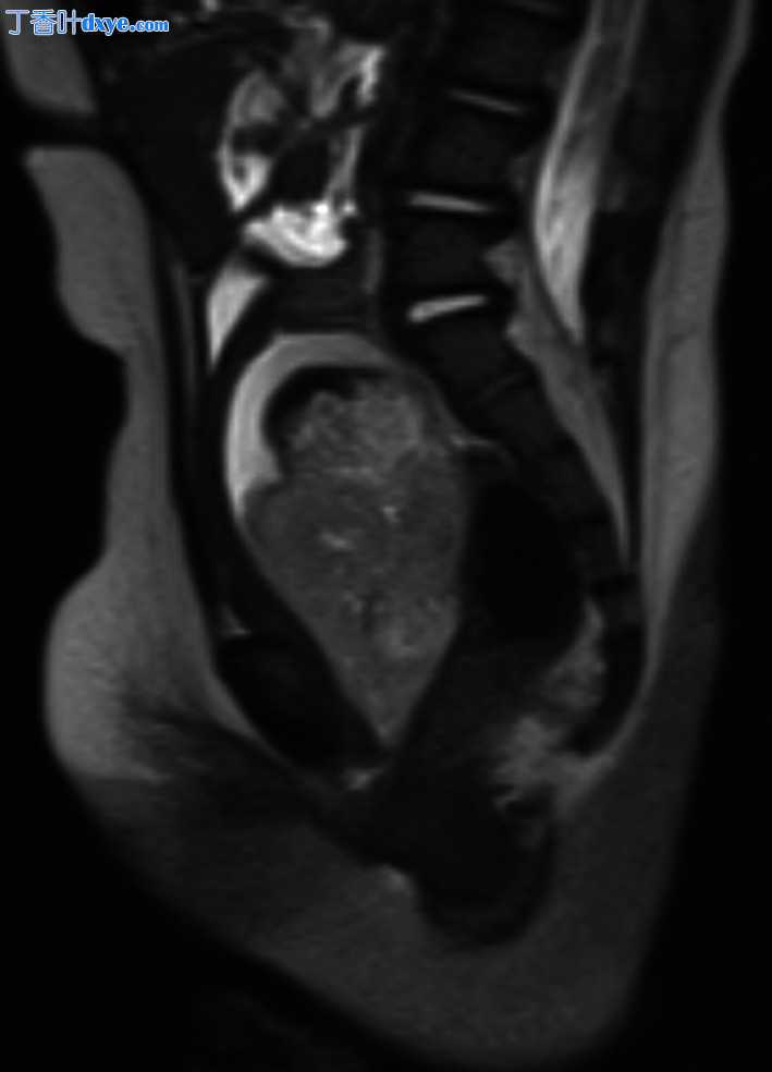 新型腹腔镜/内窥镜辅助后矢状入路切除阴道卵黄囊肿瘤一例
