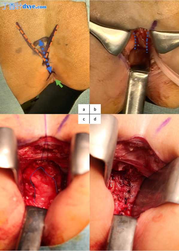 新型腹腔镜/内窥镜辅助后矢状入路切除阴道卵黄囊肿瘤一例