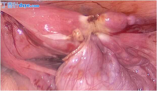 一种罕见的男性假两性畸形——持续性苗勒管综合征
