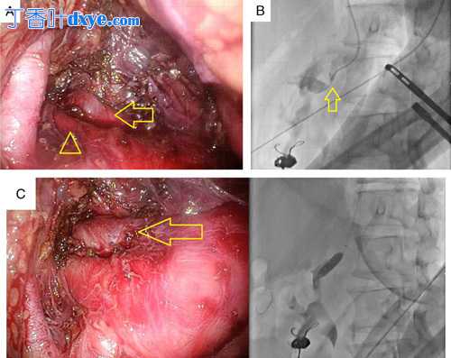腹膜后内镜正中弓状韧带切开介入放射学一例并文献复习
